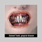 A photo of yellowish brown teeth caused by smokeless tobacco.